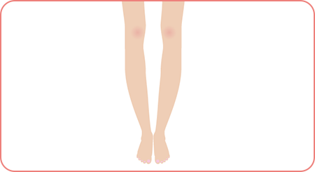 himitsu.01 O脚の軽い矯正と予防